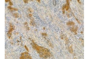 ABIN6258127 and ABIN6275841 at 1/100 staining human esophageal carcinoma by IHC-P.