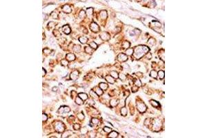 Formalin-fixed and paraffin-embedded human cancer tissue reacted with the primary antibody, which was peroxidase-conjugated to the secondary antibody, followed by AEC staining.