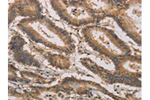 The image on the left is immunohistochemistry of paraffin-embedded Human colon cancer tissue using ABIN7190296(CLEC5A Antibody) at dilution 1/20, on the right is treated with synthetic peptide. (CLEC5A anticorps)