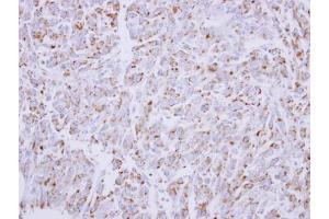 IHC-P Image Immunohistochemical analysis of paraffin-embedded U87 xenograft, using G6PD, antibody at 1:300 dilution.