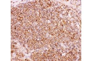 IHC-P: NFKB2 antibody testing of human lung cancer tissue (NFKB2 anticorps  (AA 1-340))