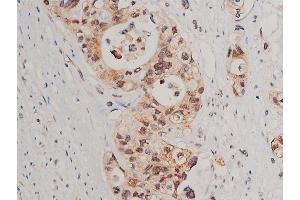 ABIN6254994 and ABIN6267520 at 1/50 staining human colon cancer tissue sections by IHC-P. (Caspase 3 anticorps  (pSer150))