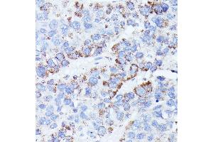 Immunohistochemistry of paraffin-embedded human liver cancer using CCDC6 antibody (ABIN7266442) at dilution of 1:100 (40x lens). (CCDC6 anticorps  (AA 55-222))