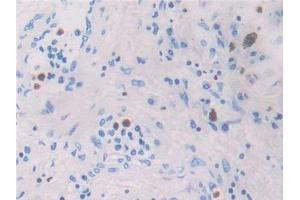 DAB staining on IHC-P; Samples: Human Lung cancer Tissue (CCL26 anticorps  (AA 24-94))