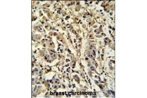 Sirt3 Antibody (C-term) (ABIN652184 and ABIN2840670) IHC analysis in formalin fixed and paraffin embedded human breast carcinoma followed by peroxidase conjugation of the secondary antibody and DAB staining. (SIRT3 anticorps  (C-Term))