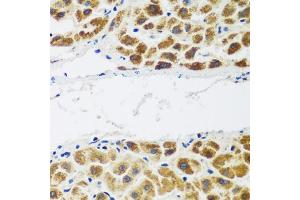 Immunohistochemistry of paraffin-embedded human liver cancer using NAA60 antibody (ABIN5975517) at dilution of 1/200 (40x lens). (NAT15 anticorps)