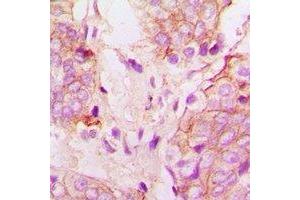Immunohistochemical analysis of Cytochrome P450 51A1 staining in human prostate cancer formalin fixed paraffin embedded tissue section.