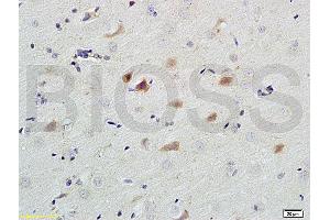 Formalin-fixed and paraffin embedded human colon carcinoma labeled with Anti-Caspase-9 Polyclonal Antibody, Unconjugated (ABIN724160) 1:200 followed by conjugation to the secondary antibody and DAB staining (Caspase 9 anticorps  (AA 11-120))