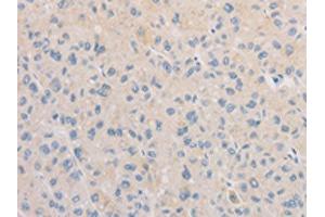 The image on the left is immunohistochemistry of paraffin-embedded Human liver cancer tissue using ABIN7129533(FNTA Antibody) at dilution 1/30, on the right is treated with fusion protein. (FNTA anticorps)