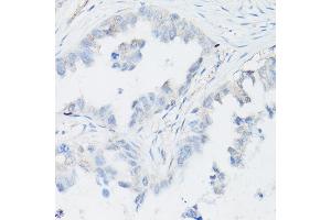 Immunohistochemistry of paraffin-embedded Human lung adenocarcinoma (negative control sample) using p63 Rabbit mAb (ABIN7271099) at dilution of 1:100 (40x lens). (p63 anticorps)