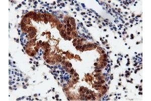 Immunohistochemical staining of paraffin-embedded Adenocarcinoma of Human endometrium tissue using anti-QPRT mouse monoclonal antibody. (QPRT anticorps)