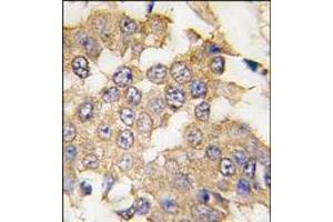 Formalin-fixed and paraffin-embedded human breast carcinoma tissue reacted with ERK2 antibody (C-term), which was peroxidase-conjugated to the secondary antibody, followed by DAB staining. (ERK2 anticorps  (C-Term))