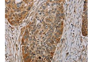 The image on the left is immunohistochemistry of paraffin-embedded Human esophagus cancer tissue using ABIN7130527(PAGE2 Antibody) at dilution 1/20, on the right is treated with fusion protein. (PAGE2 anticorps)