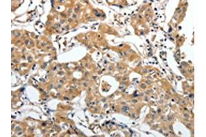 The image on the left is immunohistochemistry of paraffin-embedded Human lung cancer tissue using ABIN7192673(STEAP4 Antibody) at dilution 1/25, on the right is treated with synthetic peptide. (STEAP4 anticorps)