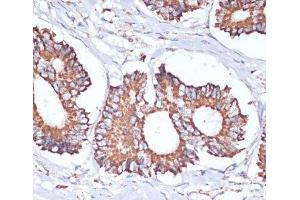 Immunohistochemistry of paraffin-embedded Human colon carcinoma using UBE2O Polyclonal Antibody at dilution of 1:100 (40x lens). (UBE2O anticorps)