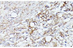 Immunohistochemistry of paraffin-embedded Human oophoroma using ACAT2 Polyclonal Antibody at dilution of 1:100 (40x lens).