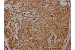 IHC image of ABIN7127675 diluted at 1:100 and staining in paraffin-embedded human cervical cancer performed on a Leica BondTM system. (Recombinant PELP1 anticorps)