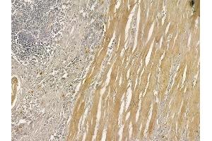 ABIN6263923 and ABIN6273281 at 1/100 staining human colon carcinoma by IHC-P. (OXA1L anticorps  (C-Term))