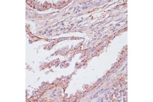 Immunohistochemistry of paraffin-embedded human lung cancer using C1 antibody (ABIN7265723) at dilution of 1:100 (40x lens).