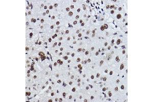 Immunohistochemistry of paraffin-embedded human liver cancer using EXOSC7 Rabbit mAb (ABIN7267064) at dilution of 1:100 (40x lens).