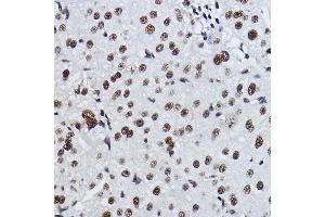 Immunohistochemistry of paraffin-embedded human liver cancer using EXOSC7 Rabbit mAb (ABIN7267064) at dilution of 1:100 (40x lens). (EXOSC7 anticorps)