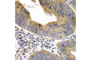 Immunohistochemistry of paraffin-embedded human colon cancer using HSPB8 antibody (ABIN5971347) at dilution of 1/200 (40x lens). (HSPB8 anticorps)