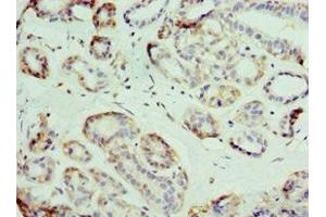 Immunohistochemistry of paraffin-embedded human breast cancer using ABIN7176713 at dilution of 1:100 (SLC39A6 anticorps  (AA 170-320))