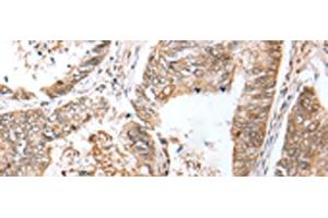 Immunohistochemistry of paraffin-embedded Human colorectal cancer tissue using LRRC19 Polyclonal Antibody at dilution of 1:30(x200) (LRRC19 anticorps)
