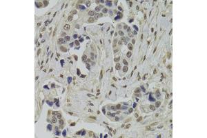 Immunohistochemistry of paraffin-embedded human breast cancer using INTS6 Antibody. (INTS6 anticorps)
