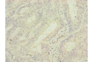 Immunohistochemistry of paraffin-embedded human endometrial cancer using ABIN7142279 at dilution of 1:100 (MRPS6 anticorps  (AA 1-125))