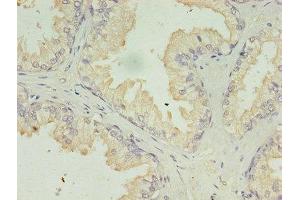 Immunohistochemistry of paraffin-embedded human prostate cancer using ABIN7142322 at dilution of 1:100 (ACAA1 anticorps  (AA 27-331))