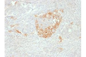 Formalin-fixed, paraffin-embedded human Neuroendocrine tumor stained with NSE gamma Mouse Monoclonal Antibody (NSE-P2). (ENO2/NSE anticorps  (AA 416-433))