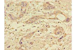 Immunohistochemistry of paraffin-embedded human pancreatic cancer using ABIN7169312 at dilution of 1:100