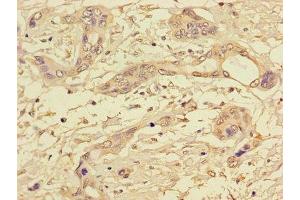 Immunohistochemistry of paraffin-embedded human pancreatic cancer using ABIN7169312 at dilution of 1:100 (PPP1CC anticorps  (Catalytic Subunit))