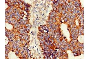 Immunohistochemistry of paraffin-embedded human colon cancer using ABIN7144717 at dilution of 1:100