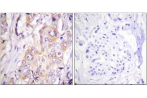 Immunohistochemistry analysis of paraffin-embedded human breast carcinoma, using MEK1 (Phospho-Thr286) Antibody. (MEK1 anticorps  (pThr286))