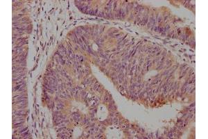 IHC image of ABIN7147175 diluted at 1:500 and staining in paraffin-embedded human lung cancer tissue performed on a Leica BondTM system.