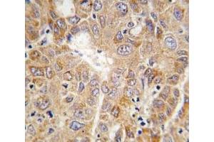 IHC analysis of FFPE human hepatocarcinoma tissue stained with PGK1 antibody