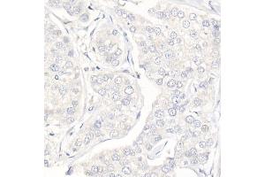 Immunohistochemistry of paraffin-embedded Human triple negative breast cancer (negative control sample) using Progesterone Receptor Rabbit mAb (ABIN7269533) at dilution of 1:100 (40x lens). (Progesterone Receptor anticorps)