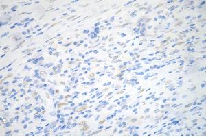 Immunohistochemistry was performed on paraffin-embedded human sigmoid colon carcinoma using PCYT1A antibody (ABIN7799789), 1:200). (Recombinant PCYT1A anticorps)