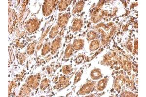 IHC-P Image BCL2L12 antibody detects BCL2L12 protein at cytosol and nucleus on human colon carcinoma by immunohistochemical analysis.
