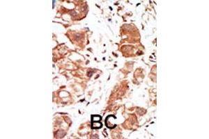 Formalin-fixed and paraffin-embedded human cancer tissue reacted with the PIM1 polyclonal antibody  , which was peroxidase-conjugated to the secondary antibody, followed by DAB staining. (PIM1 anticorps  (C-Term))