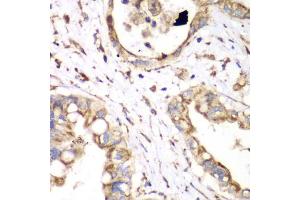 Immunohistochemistry of paraffin-embedded human liver cancer using HADHA antibody. (HADHA anticorps)