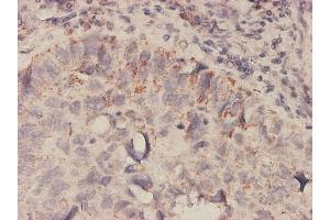 Immunoperoxidase of monoclonal antibody to MIF on formalin-fixed paraffin-embedded human lung, adenosquamous cell carcinoma tissue.