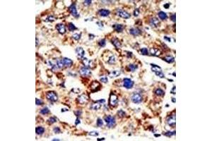 Formalin-fixed and paraffin-embedded human cancer tissue reacted with the primary antibody, which was peroxidase-conjugated to the secondary antibody, followed by AEC staining. (HDAC8 anticorps  (N-Term))