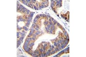 Formalin fixed and paraffin embedded human prostate carcinoma reacted with FAM109A Antibody (N-term) followed by peroxidase conjugation of the secondary antibody and DAB staining.
