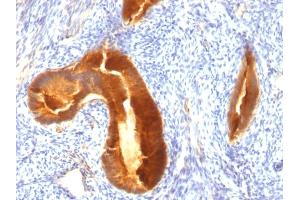 Formalin-fixed, paraffin-embedded human Endometrial Carcinoma stained with MUC-1 / CA15-3 / EMA Mouse Monoclonal Antibody (MUC1/955). (MUC1 anticorps)