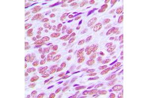 Immunohistochemical analysis of Cyclin E1 staining in human breast cancer formalin fixed paraffin embedded tissue section.
