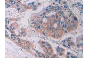 Detection of PTK7 in Human Breast cancer Tissue using Polyclonal Antibody to Tyrosine Protein Kinase 7 (PTK7)