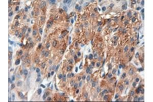 Immunohistochemical staining of paraffin-embedded Carcinoma of liver using anti-PTCH1 (ABIN2452537) mouse monoclonal antibody. (Patched 1 anticorps  (AA 122-436))